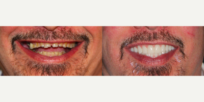 All-on-4 Dental Implants - All-on-4 Dental Implants