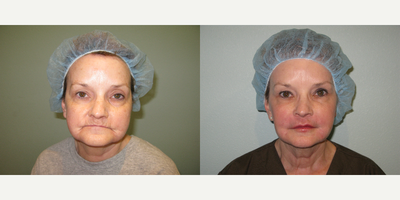55-64 year old woman treated with CO2 Laser - Before and after SmartSkin CO2 laser resurfacing, Botox to glabella and crows feet, Radiesse to cheeks, Juvederm to lips, and SmartLipo to neck/jowls.