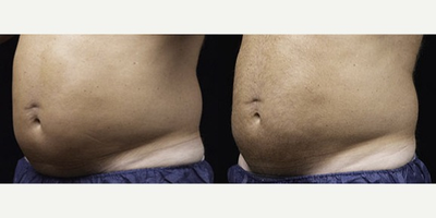 Liposonix - Liposonix
