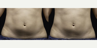 25-34 year old woman treated with Liposonix - Liposonix