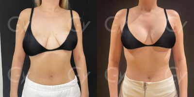 25-34 year old woman treated with Breast Lift - 25-34 year old woman treated with Breast Lift by M.D. Gray Yeiladal