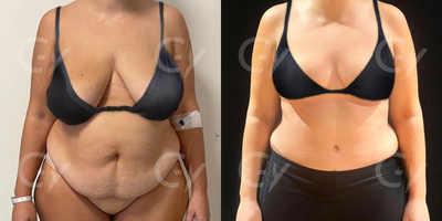 55-64 year old woman treated with Mommy Makeover - 55-64 year old woman treated with Mommy Makeover by M.D. Gray Yeiladal