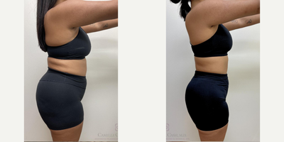 Semaglutide for weight loss with Evolve Transform treatments for proactive skin tightening - This patient is seen here before and 27 weeks later.During her once weekly rounds of my #CashedOut Semaglutide Weight Loss program, which also includes a separate B-12 injection for energy, she received EvolveX Transform body sculpting treatments. These hands-free, pain-free treatments combine the benefits of radiofrequency (RF) energy and electrical muscle stimulation (EMS) to sculpt, tone, and tighten various areas of the body. It targets stubborn fat, enhances muscle definition, and improves skin elasticity, offering a comprehensive solution for body transformation without surgery or downtime. We especially love this treatment for Semaglutide patients since they can be safely performed throughout ones weight loss journey as a proactive measure against loose skin caused by rapid volume loss, a common concern known in pop-culture as Ozempic Butt.She is seen here before and 27 weeks after starting our Semaglutide weight loss program. At 51, her weight loss from 176 to 155 significantly reduced her BMI from 33.3 (obesity range) to a much healthier BMI of 29.4.