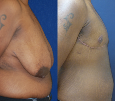 45-54 year old woman treated with Mastectomy - This patient is 46 years old, 57 and weighs 184 Lbs. He had a Bilateral Total Mastectomy with Free Nipple and Areolar Complex.
