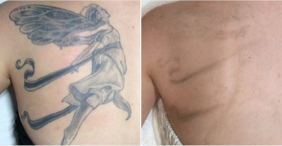 Before and after 5 Enlighten tattoo removal treatments - Just 5 treatments with Enlighten laser tattoo removal.