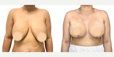 35-44 year old woman treated with Breast Implant Removal, Breast Reconstruction, Breast Lift - Breast implant removal is more than just removing the prosthesis and capsules. It's reconstructive surgery that has aesthetic goals for our patients. The great thing about this surgery is that we can use the patient's tissue for reconstruction, allowing immediate results. Plus, it's almost always painless and leaves an L-shaped scar with no scars in the cleavage area. Thanks to the BRALAN Technique(Breast Reconstruction Anatomical Lift Augmentation), we can achieve a consistent and stable aesthetic result regardless of breast tissue size.