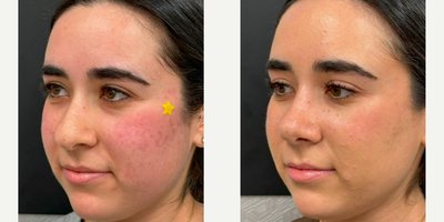 Woman treated with Rhinoplasty - Rhinoplasty