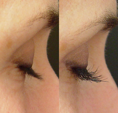 Lashes treated with Lumigan/Latisse - This is a patient who was one of the first people we tried Lumigan on before it became Latisse.&nbsp;