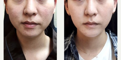 45-54 year old woman treated with Radiesse, Juvederm - Before and after images show patients aged 3055 who underwent advanced lifting treatments such as Titanium Lifting, Ultherapy, and Thermage. These procedures are designed to improve skin firmness, refine facial contours, and support collagen regeneration, helping achieve naturally lifted and balanced results tailored to each patients skin condition