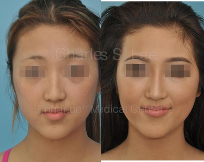 18-24 year old woman treated for Asian Rhinoplasty - 6mo after all natural rhinoplasty using ear cartilage. The tip was strengthened so that it widens less upon smiling.