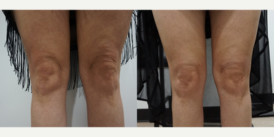35-44 year old woman treated with Liposuction Revision - 35-44 year old woman treated with Liposuction Revision