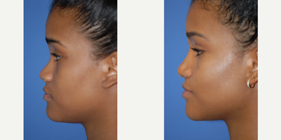 25-34 year old woman treated with Rhinoplasty - Bridge improved and tip narrowed
