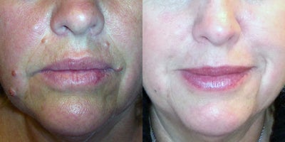 45-54 year old woman treated with Mole Removal - This patient underwent removal with radiofrequency shave technique, which contours the mole flat with the skin.  This technique is frequently used by Dr. Andrade for raised moles because it does not distort the surrounding facial anatomy, and often heals without a significant mark or scar.