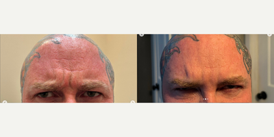 Man treated with Daxxify - Man treated with Daxxify
