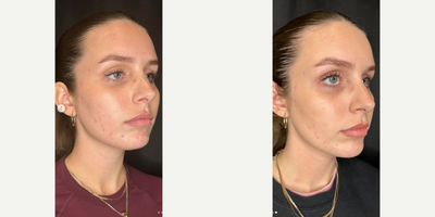Woman treated with Chemical Peel, VI Peel - Woman treated with Chemical Peel, VI Peel