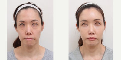 45-54 year old woman treated with Nonsurgical Facelift - To address facial volume loss and soften overall facial lines, a minimally invasive, non-incisional lifting approach using autologous fat transfer was performed.For hollow, tired-looking under-eye areas, a non-incisional fat repositioning technique was used to restore volume and improve the transition