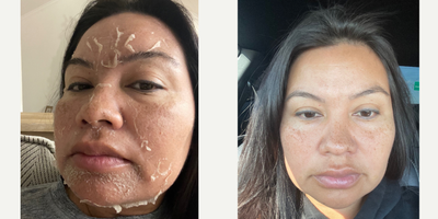 25-34 year old woman treated with Chemical Peel - Melanage Peel By Christine in Austin TX