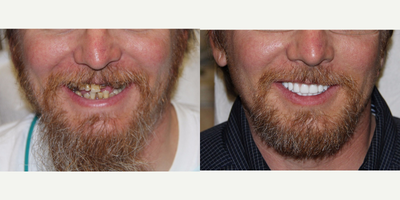35-44 year old man treated with All-on-4 Dental Implants - All-on-4 Dental Implants