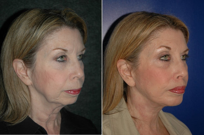 Lip Repositioning - Lip Lift + Chin Implant + Deep Plane Facelift
