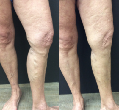 45-54 year old woman treated with Varithena - Varicose veins before and after a great result with Varithena, a phlebectomy, and sclerotherapy.