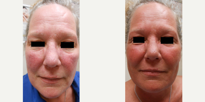 45-54 year old woman treated with Laser Treatment - Before & After 2 Treatments of Three for Me (IPL & 1540 Fractional). More pictures and results to come!