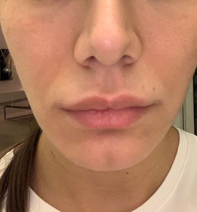 facial slimming review botox buzele îți pierd greutatea