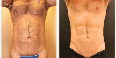 46 year old man treated with Liposuction - This male patient aged 46 was treated with liposuction of the abdomen and hips. The after photo taken was taken 8 months post-surgery.