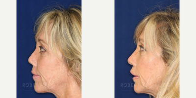 Permanent Non-surgical Revision Rhinoplasty - Permanent Non-surgical Revision Rhinoplasty after 5 surgical rhinoplasties. Restoration of amputated columella. Correction of irregular bridge. Restoration to natural tip. All leading to a nose that no longer appears over operated.