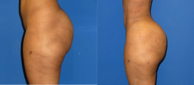 25-34 year old woman treated with Butt Implants - 6 Month Post Op from Butt Augmentation with Implants