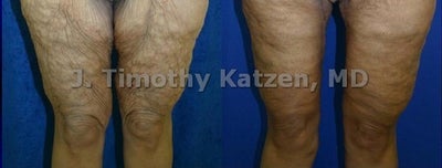 Thigh Lift after massive weight loss - Before and after picture of inner thigh lift after massive weight loss. - Individual Results May Vary