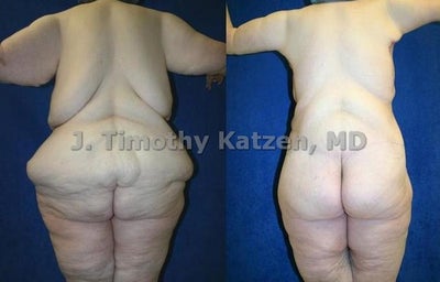 Torso Back Reduction - This is a 40 year old female who initially weighed 500 pounds. She underwent duodenal switch and lost 232 pounds. After her massive weight loss, she did not like the excess rolls of her abdomen, hips, and buttocks. First, she underwent a 360 bodylift. One month later she underwent a horizontal torsoplasty or back lift. Dr. Katzen removed 15 pounds from the torsplasty. - Individual Results May Vary