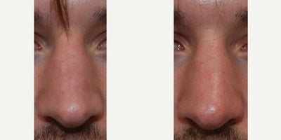 Permanent Non-Surgical Rhinoplasty Before & After: Correcting Congenital Nasal Tip Indentation - Our handsome patient came to see us from out of state because of a congenital indentation involving his left nasal tip cartilage. He had noticed it for around 5 years and was looking for a permanent solution to improve his nasal tip symmetry without undergoing rhinoplasty surgery. In his after photo, you can see a more symmetrical and natural-looking nasal tip appearance without the indentation. Unlike temporary gel fillers, such as HA, microdroplet Silikon-1000 nasal injections are never associated with necrosis, embolus, blindness, stroke, infection, or biofilm.