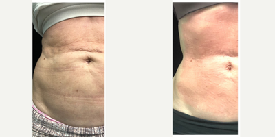 45-54 year old woman treated with Velashape - After 6 Velashape treatments and 1 RF Microneedling treatment