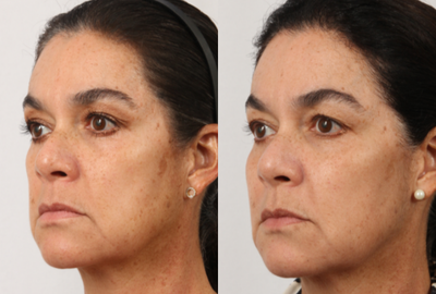 45-54 year old woman treated with LaseMD - This patient had one LaseMD treatment combined with a proper skincare routine. She saw a vast improvement in her overall tone and texture.