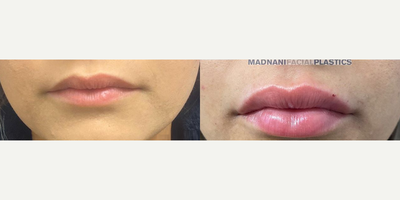 Woman treated with Juvederm - This is immediately after 1 syringe of Juvederm Volbella XC.