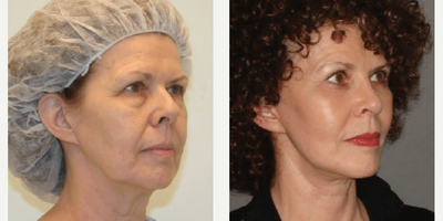 Woman treated with Facelift - Woman treated with Facelift