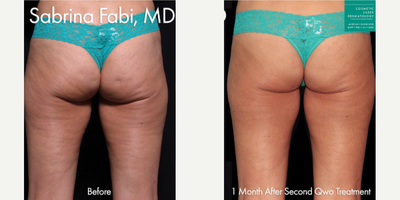 35-44 year old woman treated with Qwo - Qwo use to to treat cellulite on the buttocks of a female patient by Dr. Fabi.