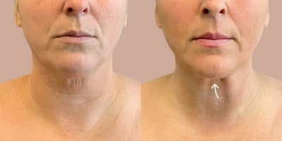 45-54 year old woman treated with AirSculpt - Patient received Airsculpt on her chin and jowl. Notice the skin tightening on her neckline, giving a more youthful look. Results are 6 months post-op.
