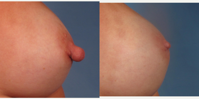 45-54 year old woman treated with Nipple Reduction Surgery and Breast Implant Exchange - This woman had changes in the breasts after childbirth and breast feeding. She wanted the implants exchanged and the nipples reduced