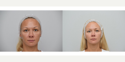 25-34 year old woman treated with PicoWay, Skin Rejuvenation, SkinCeuticals - Picoway Laser with combination of skin care by Skin Ceuticals was used to treat melasma and skin rejuvenation.