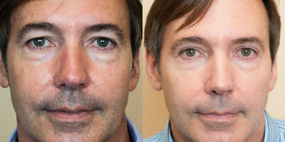 45-54 year old man treated with Eyelid Surgery - Dan underwent both an upper and lower eyelid blepharoplasty. He is a pilot who is active bot was feeling like he looked more tired than he felt. The combined eyelid surgery helped restore a more refreshed and natural appearance.