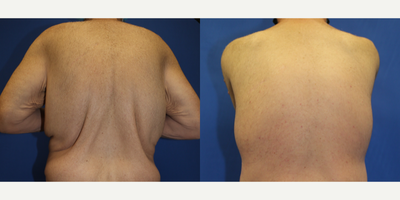 35-44 year old man treated with Back Lift - This is a male patient who lost a significant amount of weight and was not happy with the excess skin and fat in his back area. He underwent a vertical torsoplasty, also known as upper back lift, with Dr. Timothy Katzen. Notice how much better his back looks. He is happy with the results of his torsoplasty.