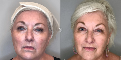 Woman treated with NovaThreads - Woman treated with NovaThreads
