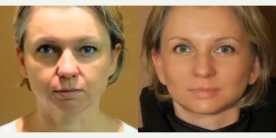 Woman treated with Eyelid Surgery - Woman treated with Eyelid Surgery