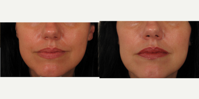 45-54 year old woman treated with Silhouette InstaLift - 45-54 year old woman treated with Silhouette InstaLift