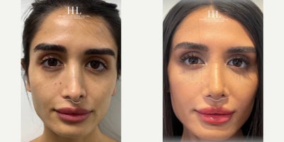 Woman treated with Revision Rhinoplasty - Woman treated with Revision Rhinoplasty with septal cartilage grafting to enhance the appearance of the nose as well as the functionality of the breathing mechanism. Pre-op, patient had a closed Rhinoplasty a few years ago and she has been discontent with the length, shape, and inability to breathe through the nose. Patient is shown before and 9 days post-op.