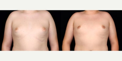 16 year old man treated with Gynecomastia Surgery - 16 year old man treated with Gynecomastia Surgery. Photos depict before and one year after surgery.
