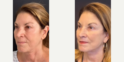 Woman treated with Facial Fat Transfer - Woman treated with Deep Plane Facelift, Neck Lift, Brow Lift, Lip Lift, and Facial Fat Transfer. Post-op, patient looks refreshed.