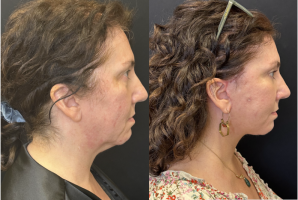 57 year old woman treated with CO2 Laser - 57 year old woman treated with CO2 Laser