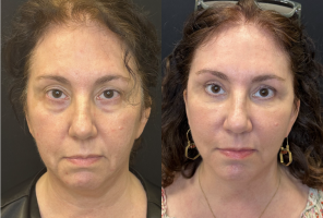 57 year old woman treated with CO2 Laser - 57 year old woman treated with CO2 Laser